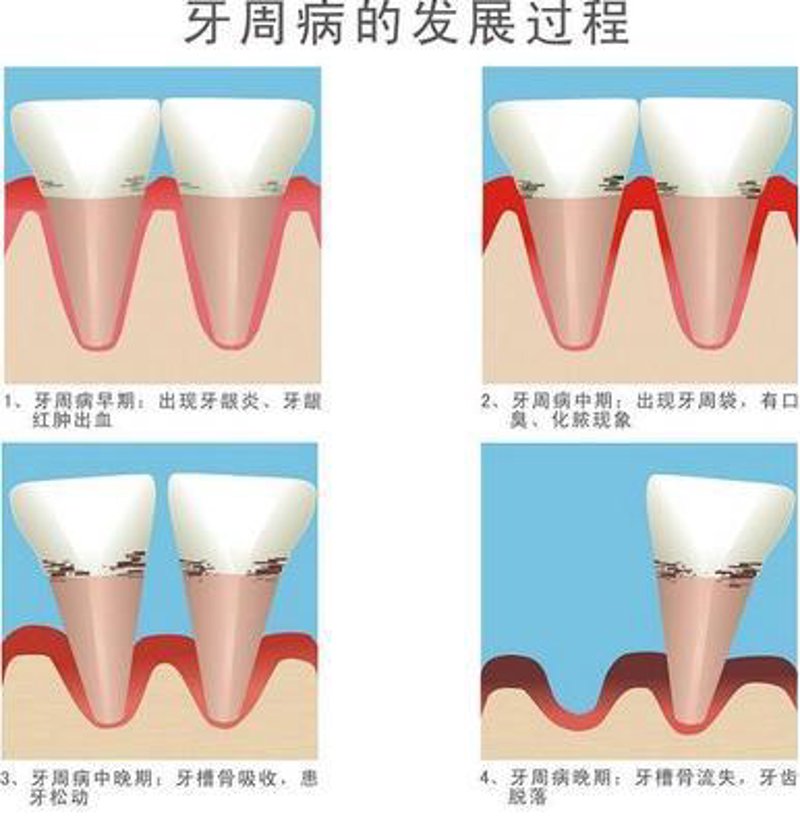 牙周治疗多少钱
