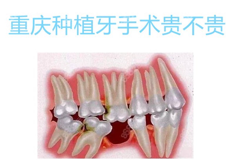 牙周治疗视频全过程：图解与真人实拍对比，谁更胜一筹？