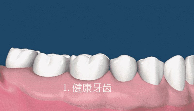 隐形牙套vs钢丝牙套：矫正选择，别再被忽悠了